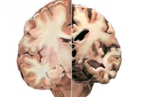 Новое лекарство от болезни Альцгеймера [восстановило память у мышей]