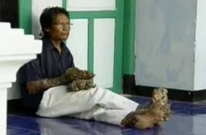 «Человека-дерево» [будут оперировать дважды в год]