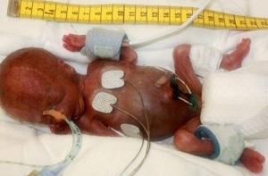 В Германии родился ребенок весом меньше банки Колы