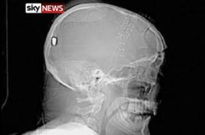 У британца с подозрением на инсульт нашли в голове пулю