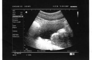 Женщин обяжут проходить УЗИ перед абортом