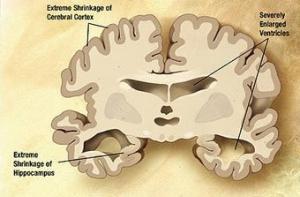 Болезнь Альцгеймера обходится миру в сотни миллиардов долларов