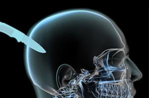 Бразилец три года ходил с ножом в голове