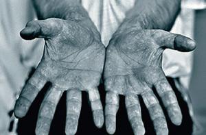 Микрохирурги бесплатно помогут нищим с больными руками