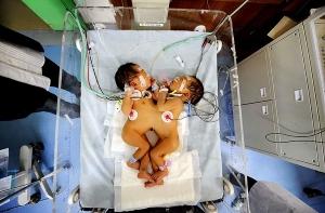 В Китае провели операцию по разделению сиамских близнецов