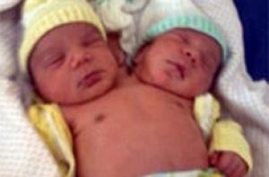 В Бразилии родился двухголовый малыш