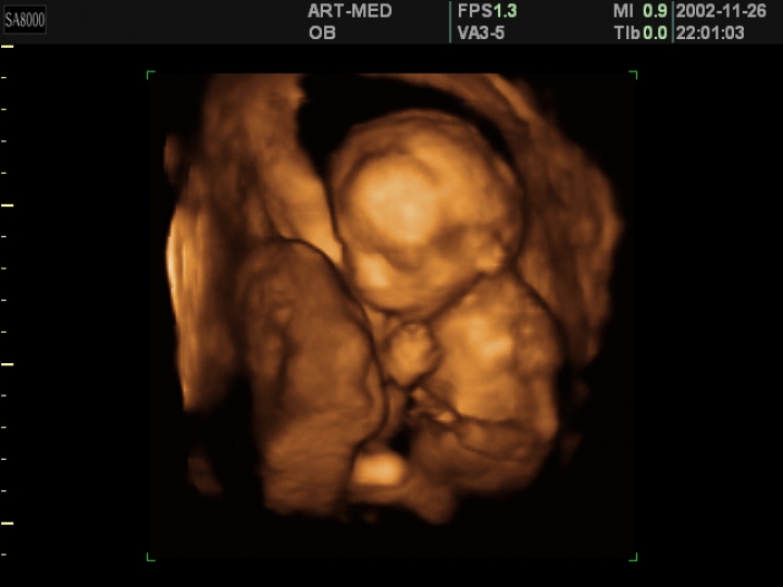 В Латвии аборты хотят приравнять к уголовному преступлению