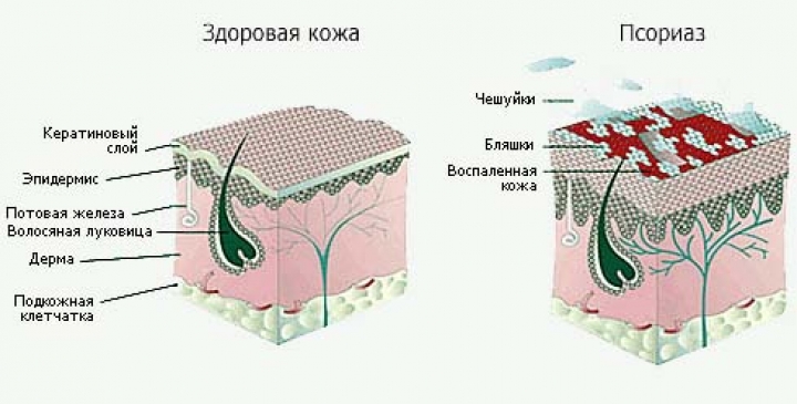 В Латвии отметят День псориаза