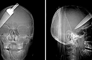 Мужчина 17 лет жил с ножом в голове