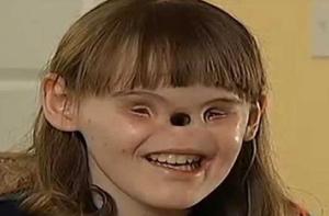 В США врачи создают девочке нос через 16 лет после её рождения (ФОТО, ВИДЕО)