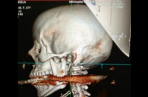 Бразильянка выжила после того, как ей в рот попал стальной гарпун (ВИДЕО)