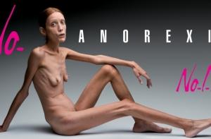 В генах найдена причина анорексии