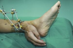 Рабочему пришили оторванную руку к ноге (ФОТО)