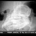 Женщина 40 лет вынашивала мумию (ВИДЕО)