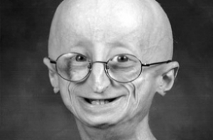 Американский мальчик умер от старости в 17 лет (ВИДЕО)