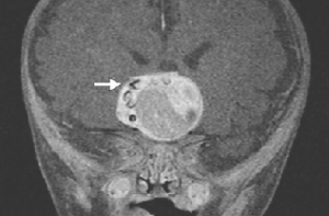 Неожиданная находка: из мозга ребенка извлекли настоящий зуб