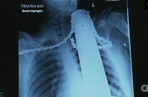 Американец выжил после того, как в его шею вошла включенная бензопила (ФОТО)