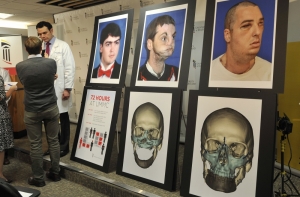 Мужчина с пересаженным лицом стал фотомоделью