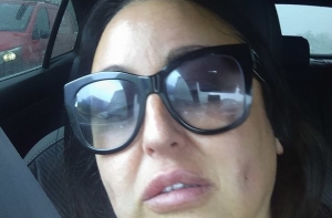 Сделали, блин! Пациентка заплатила 130 тыс., чтобы ей сделали ямочки на щеках