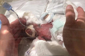 Медики выходили самого маленького недоношенного ребенка