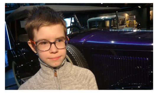 «Зеленая лампа»:  спасти руку 13-летнему Артуру