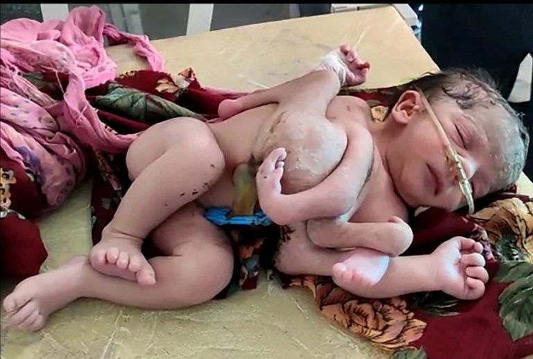 В Индии родилась девочка с четырьмя ногами и тремя руками