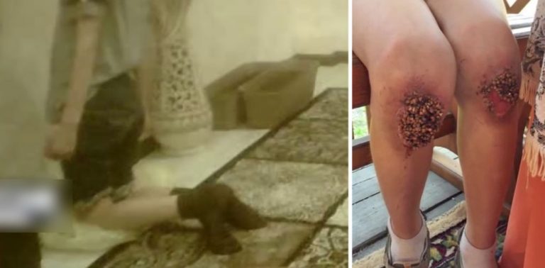 В Омске мальчика пытали в семье: в ноги ребенка вросла гречка (ФОТО, ВИДЕО)