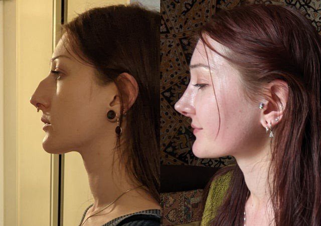 Этот нос вам к лицу — люди, которые решились на пластику и выиграли