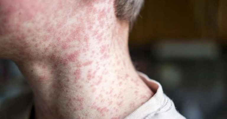 Вспышка кори в Латвии: количество инфицированных выросло до 42 человек